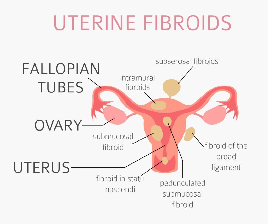 Uterine fibroids